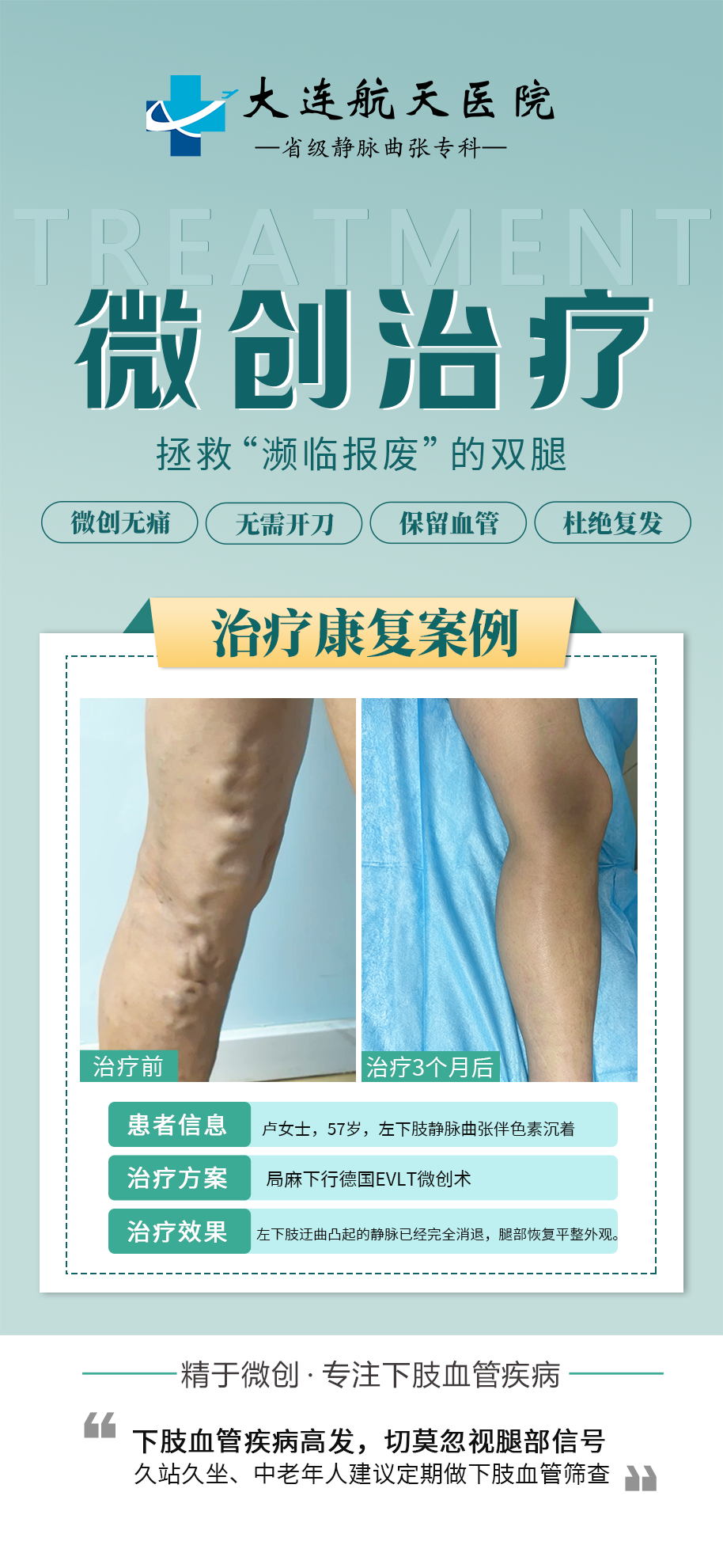 静脉曲张康复案例｜德国 EVLT 微创治疗，患者真实恢复情况 (图3)